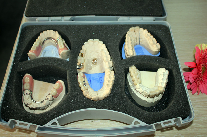 Nên cấy ghép Implant hay hàm giả cầu răng ?
