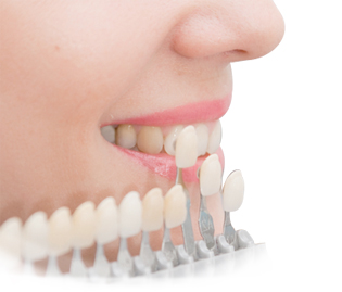 Emax Veneer mặt dán toàn sứ thẩm mỹ