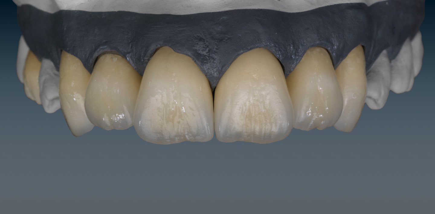 RĂNG SỨ CERAMILL